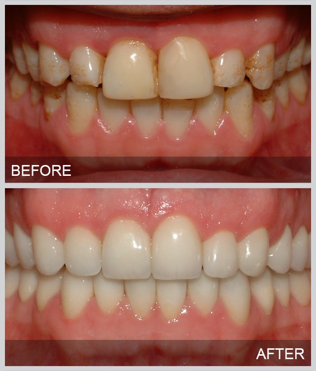 How do you restore tooth enamel?